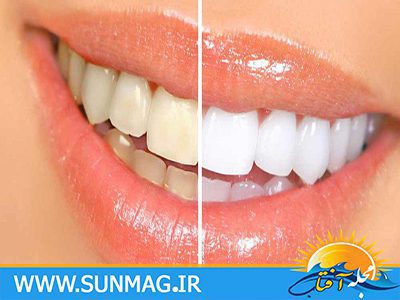 سفید کردن دندان ها به صورت طبیعی