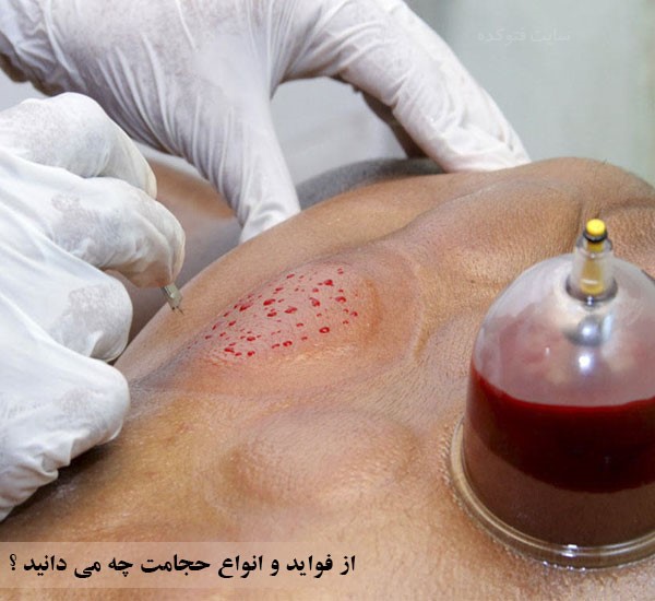 خواص حجامت + کاهش کلسترول با حجامت