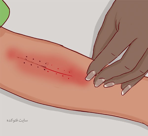 از بین بردن جای بخیه جدید و قدیم