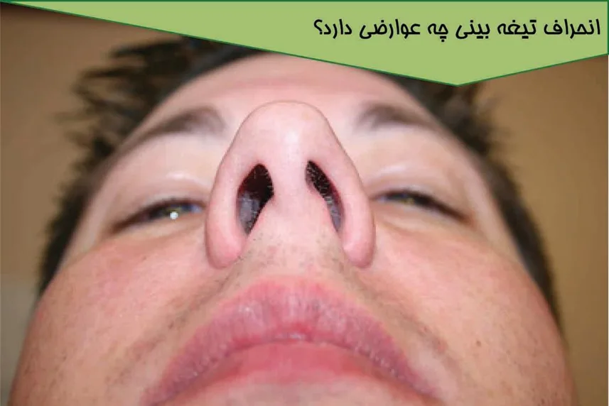 انحراف تیغه بینی چه عوارضی دارد؟