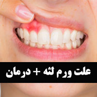 انواع ورم لثه کودکان و بزرگسالان با ۲۲ علت و درمان خانگی