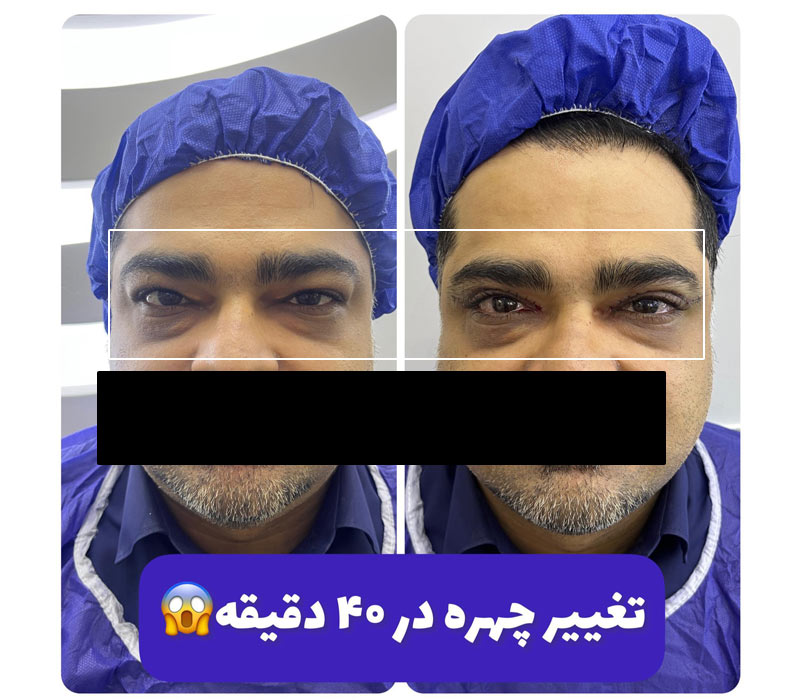 بهترین سن برای عمل بلفاروپلاستی