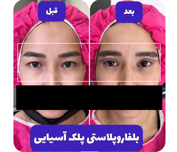 مدت زمان دوره نقاهت و مراقبت های بعد از عمل بلفاروپلاستی