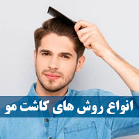بهترین روش کاشت مو در ایران + انواع روش کاشت مو چیست