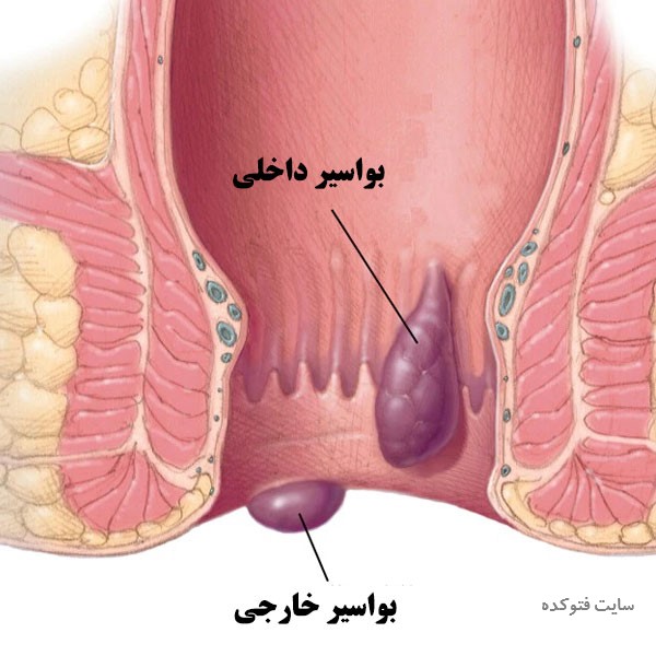 بواسیر چیست با عکس بواسیر داخلی و خارجی مقعد در زنان و مردان