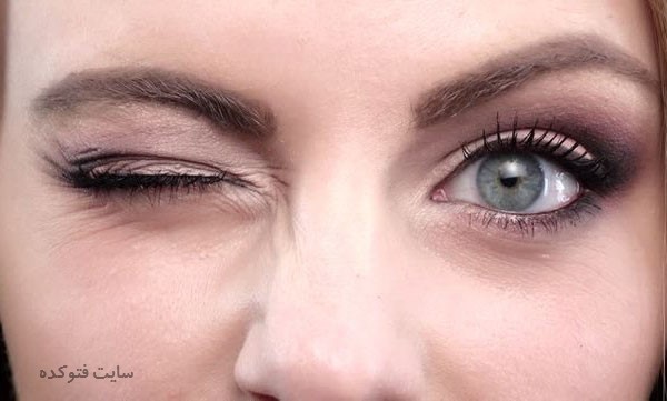 تاری ناگهانی چشم راست و چپ