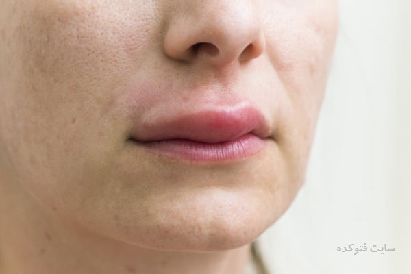 تورم بی دلیل لب + روش های درمانی در خانه با طب سنتی