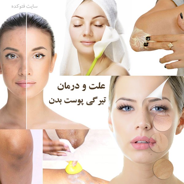 رفع تیرگی پوست صورت و بدن در خانه