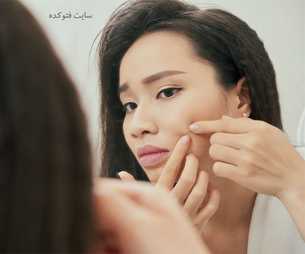 از بین بردن جوش آکنه