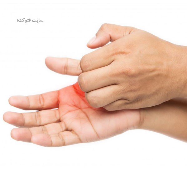 درمان خارش کف دست راست و چپ در طب سنتی