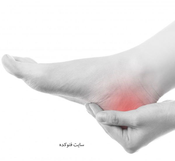 درمان درد پاشنه پا در طب سنتی و گیاهی