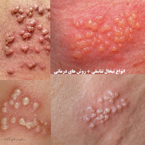 عکس شکل ظاهری تبخال تناسلی در مردان و زنان