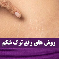 رفع ترک شکم بعد از بارداری با ۱۸ روش خانگی (جدید)