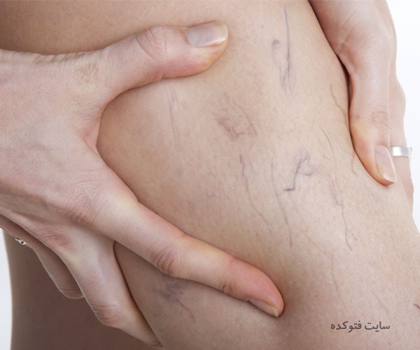 عکس روش های پیشگیری از واریس پا و بدن