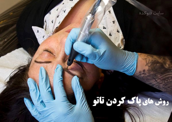 از بین بردن تاتو به روش خانگی