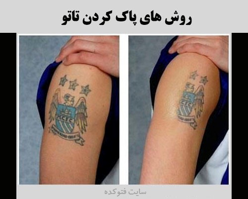 روش پاک کردن خالکوبی