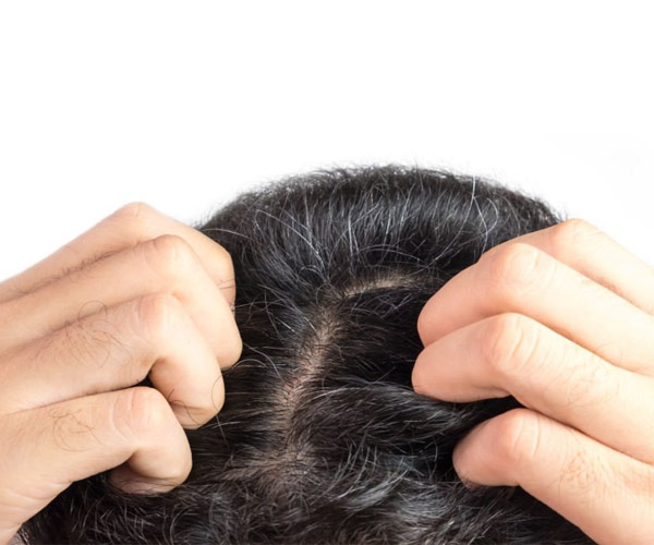 کرونا چگونه باعث ریزش مو می شود