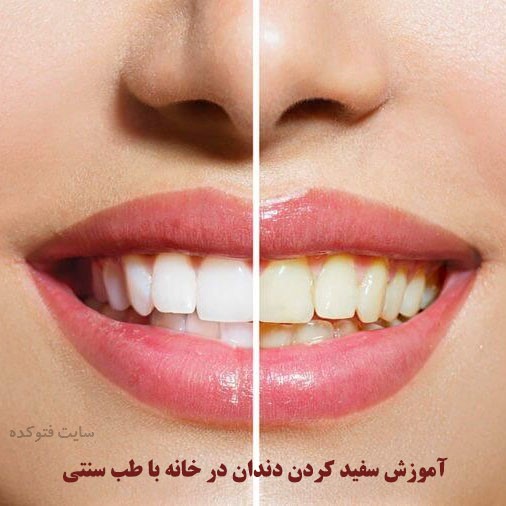 سفید کردن دندان با طب سنتی در خانه