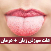 سوزش زبان و دهان + ۴۰ علت سوزش زبان با روش درمان