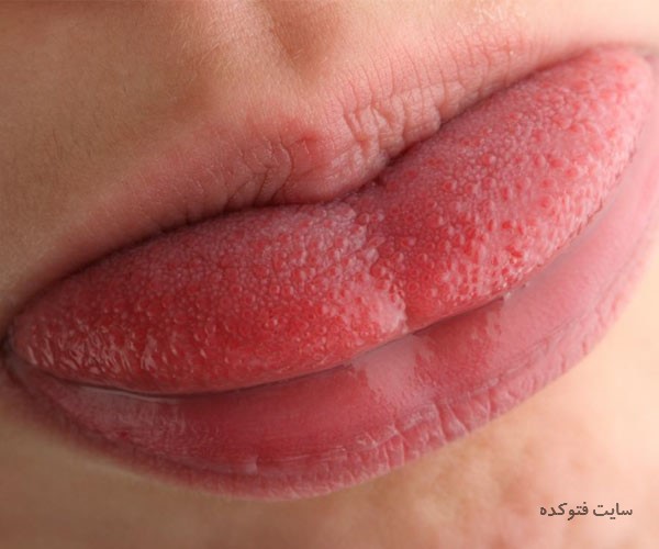 سوزش زبان علامت چیست