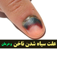 سیاه شدن ناخن دست و پا + ۲۳ علت و درمان سیاهی ناخن