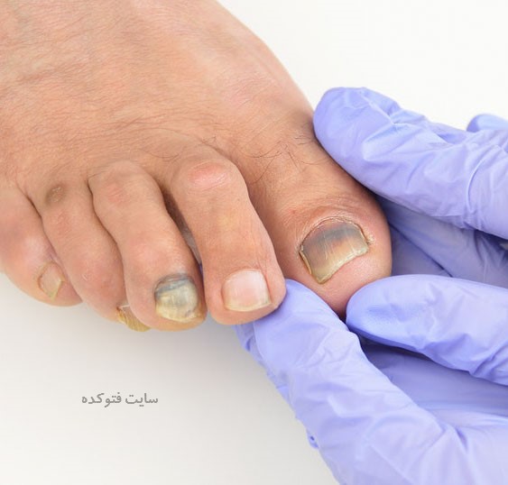علت سیاه شدن ناخن