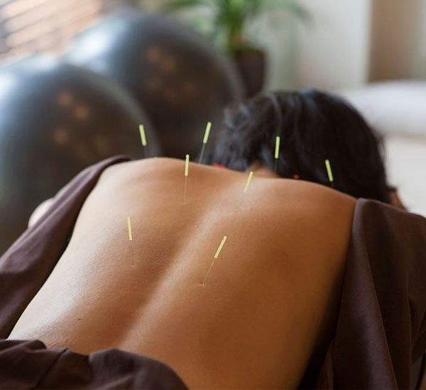 هزینه طب سوزنی با عکس نحوه انجام کار