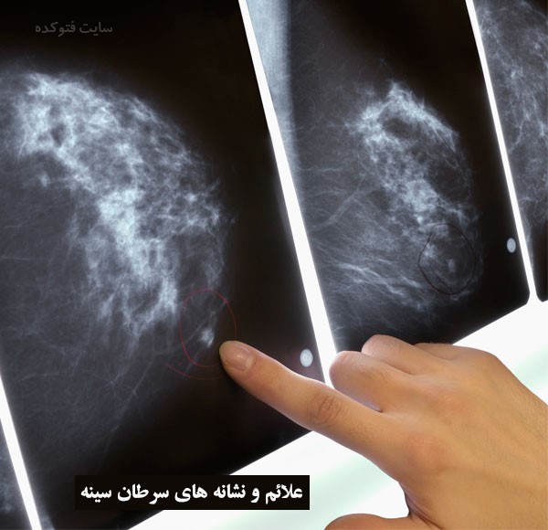 علل ایجاد سرطان سینه چیست با عکس