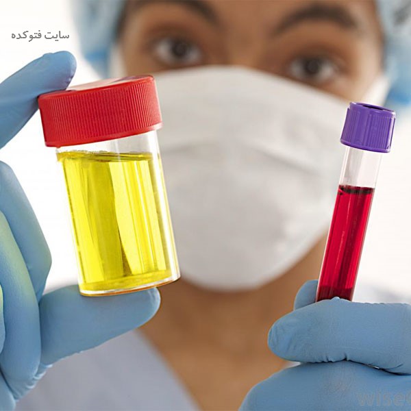 تغییرات رنگ ادراری در بارداری