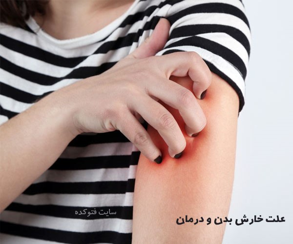 بهترین راه های درمان خارش بدن با داروهای گیاهی و طب سنتی