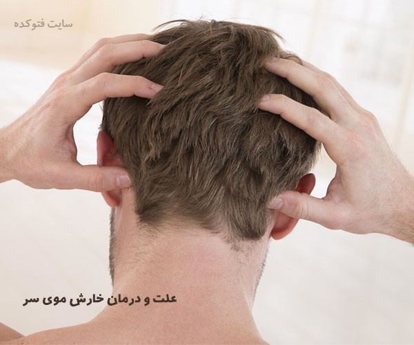 علت خارش سر و درمان خارش سر با طب سنتی و گیاهی