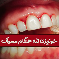 علت خونریزی لثه هنگام مسواک زدن چیست با روش جلوگیری