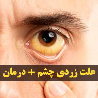 علت زردی چشم بزرگسال و نوزاد + ۲۲ دلیل و درمان خانگی