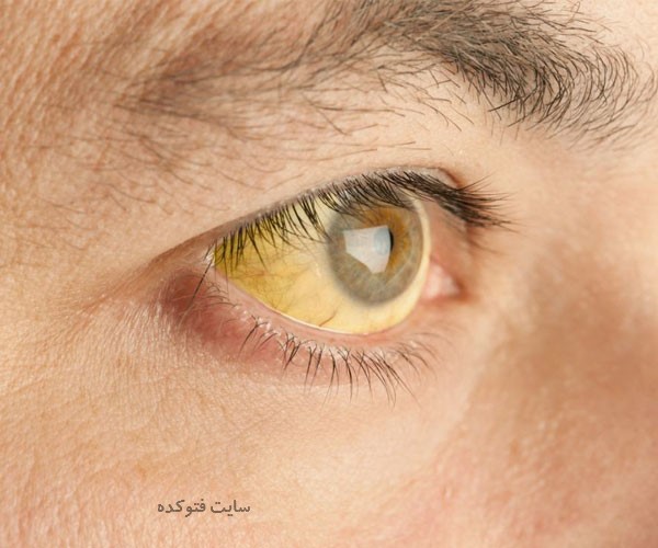 علت زردی چشم بزرگسال و نوزاد