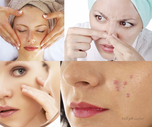 علت جوش زیر پوستی + روش های درمان