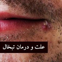 درمان سریع تبخال + علائم و درمان خانگی تبخال