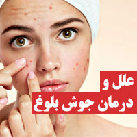 درمان جوش غرور جوانی دختران و پسران نوجوان