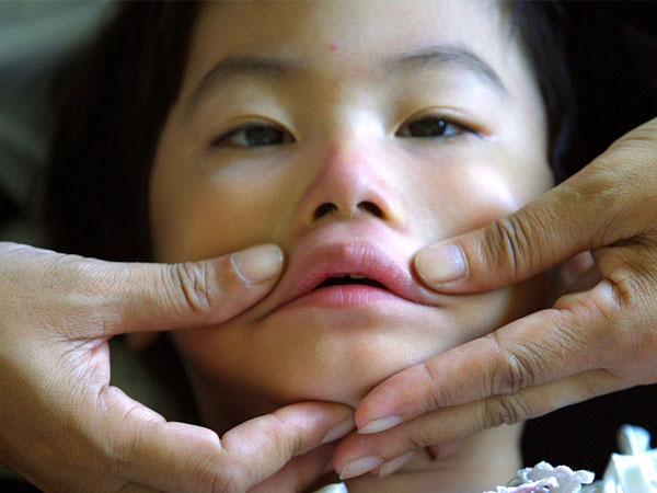آیا فلج بل Bell's palsy مسری است؟