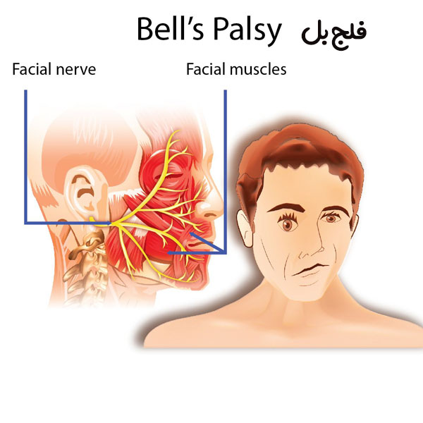 همه چیز در مورد فلج بل و بلز چیست Bell's palsy