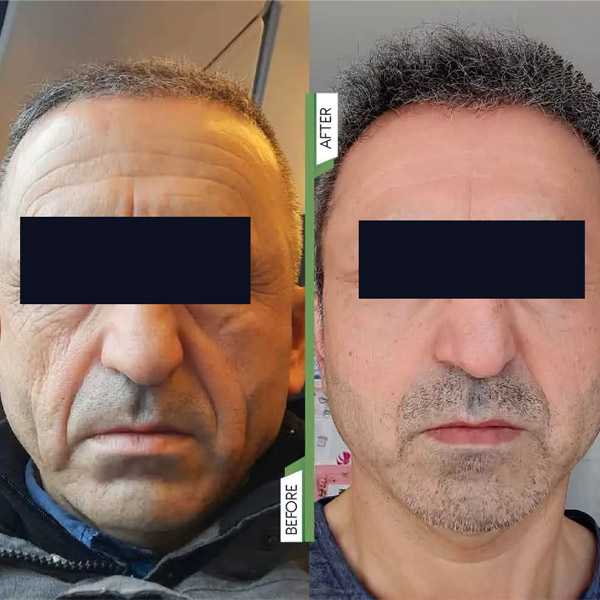 لیفت صورت با استفاده از روش هایفوتراپی