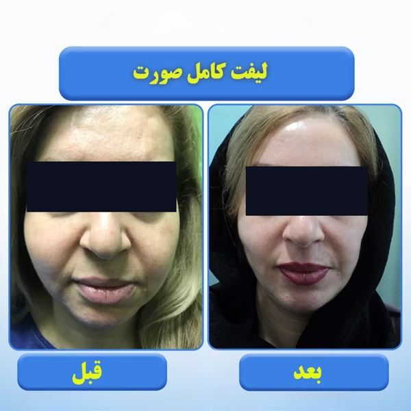 لیفت صورت به روش میکرودرم ابریژن