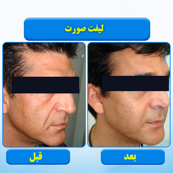 لیفت صورت به روش RF فرکشنال