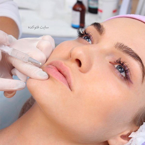 مراقبت های بعد از تزریق ژل لب