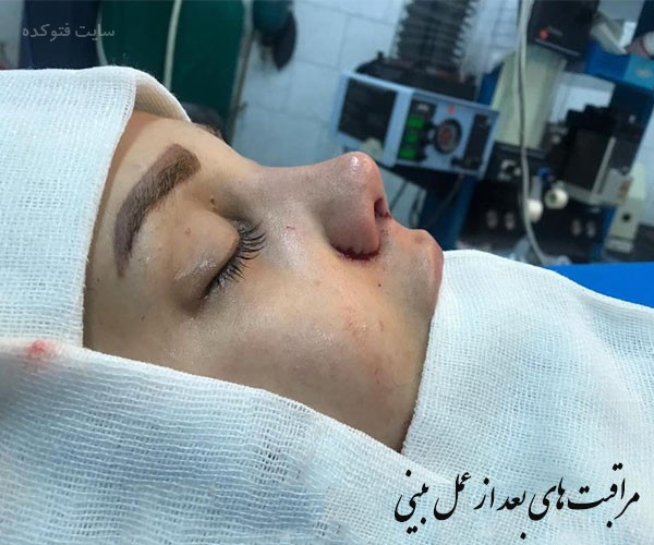 توصیه های مراقبتی بعد از عمل جراحی بینی گوشتی و استخوانی