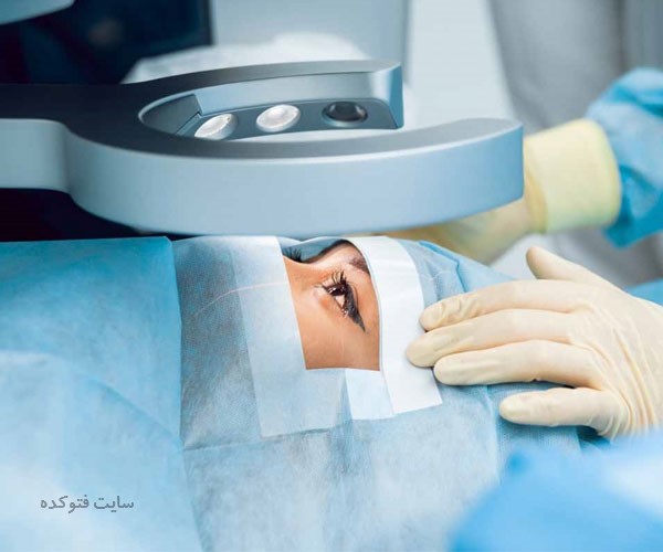 مراقبت های بعد از عمل لیزیک چشم