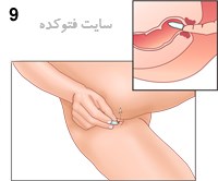 نحوه گذاشتن شیاف با آموزش تصویری + فواید و عوارض