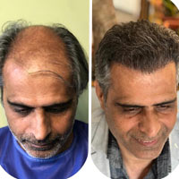 همه چیز در مورد کاشت مو و روش مراقبت قبل و بعد