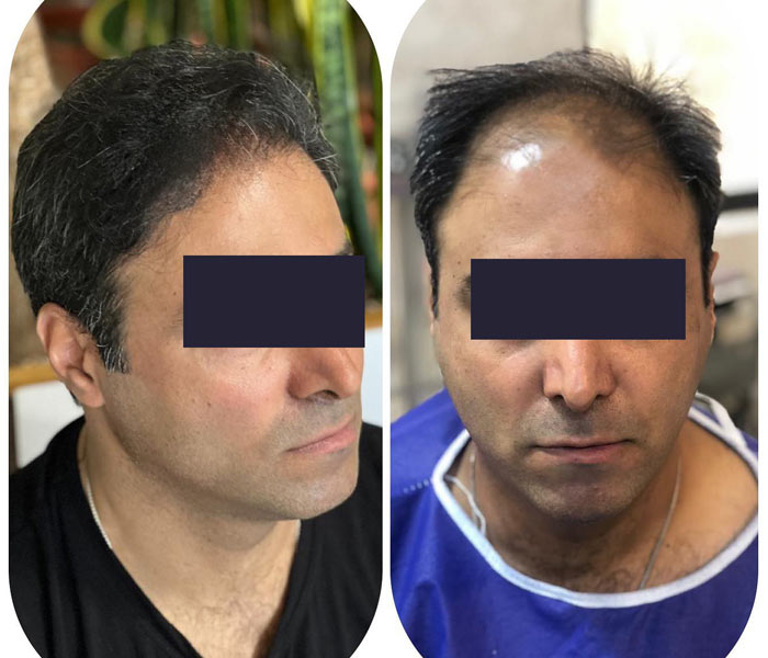 همه چیز در مورد کاشت مو و اصول مراقبت قبل و بعد
