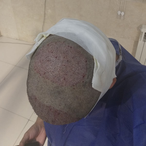 پانسمال محل برداشت مو بعد از کاشت مو