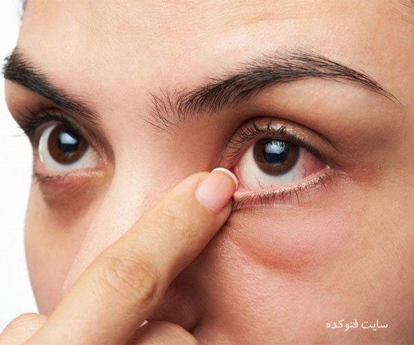 علت پرش پلک چشم با روش درمان